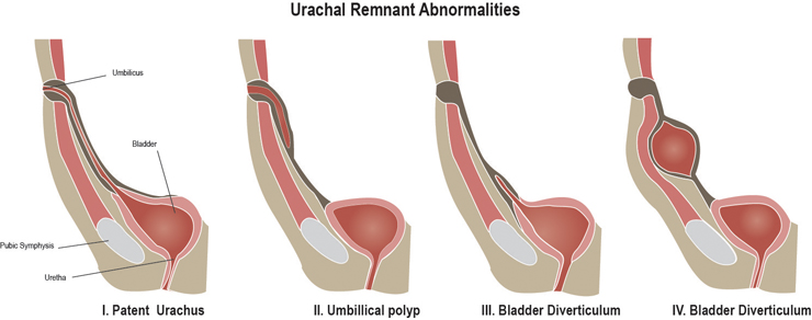 Bladder Abnormalities: Patent Urachus, Urachal Cyst, Urachal-umbilical Sinus, and Vesicourachal Diverticulum