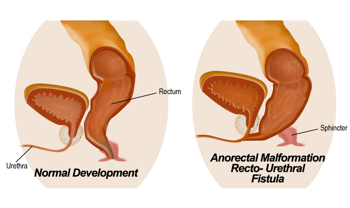 Anorectal Malformation Recto-Urethral Fistula.ladder Abnormalities: Patent Urachus, Urachal Cyst, Urachal-umbilical Sinus, and Vesicourachal Diverticulum