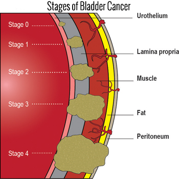 Stages of Bladder Cancer