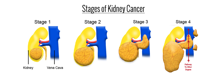 Stages of Kidney Cancer