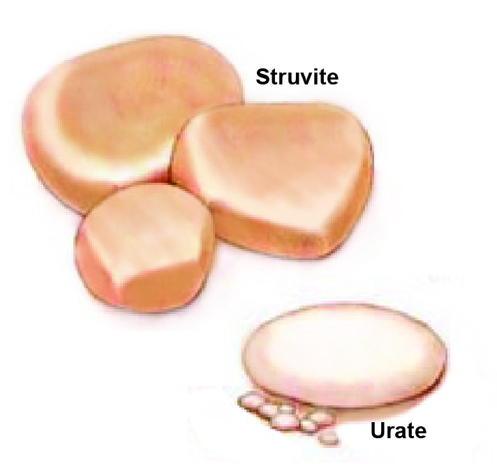 Struvite & Urate Stones